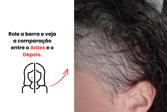 Queda de cabelo – situação inicial sem tratamento Antes da queda de cabelo visível – couro cabeludo ralo