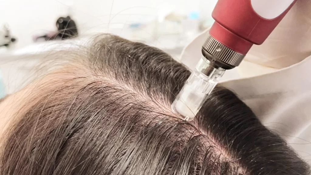 MMP Capilar: Microagulhamento + Drug Delivery para Recuperar seu Cabelo