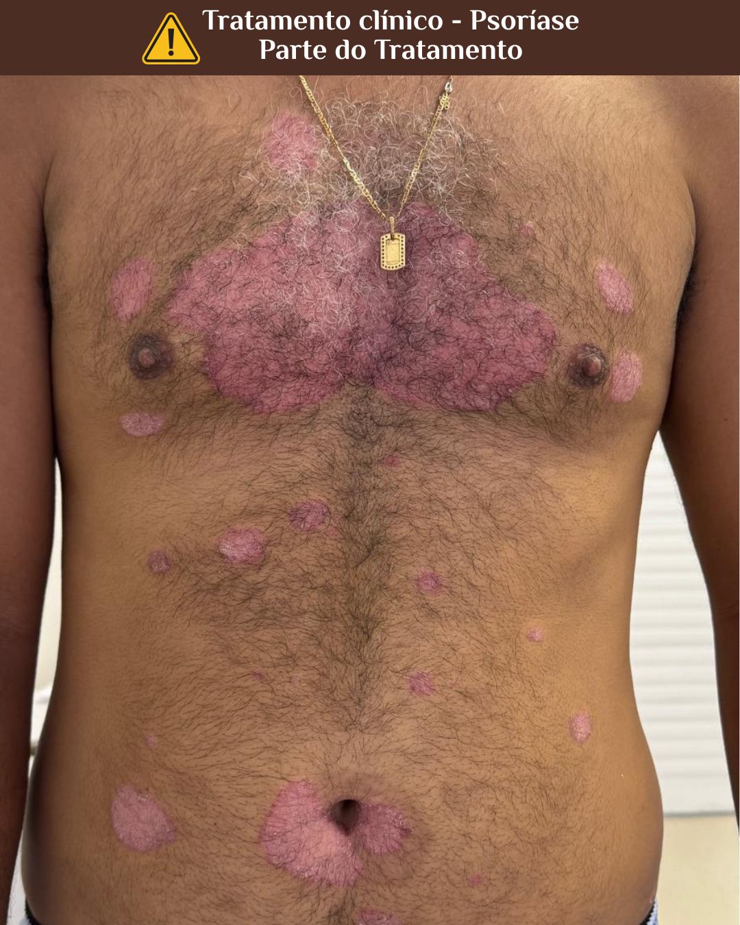 Psoríase_antes Homem sendo tratado de Psoríase. Refere-se a uma parte do tratamento. Antes.