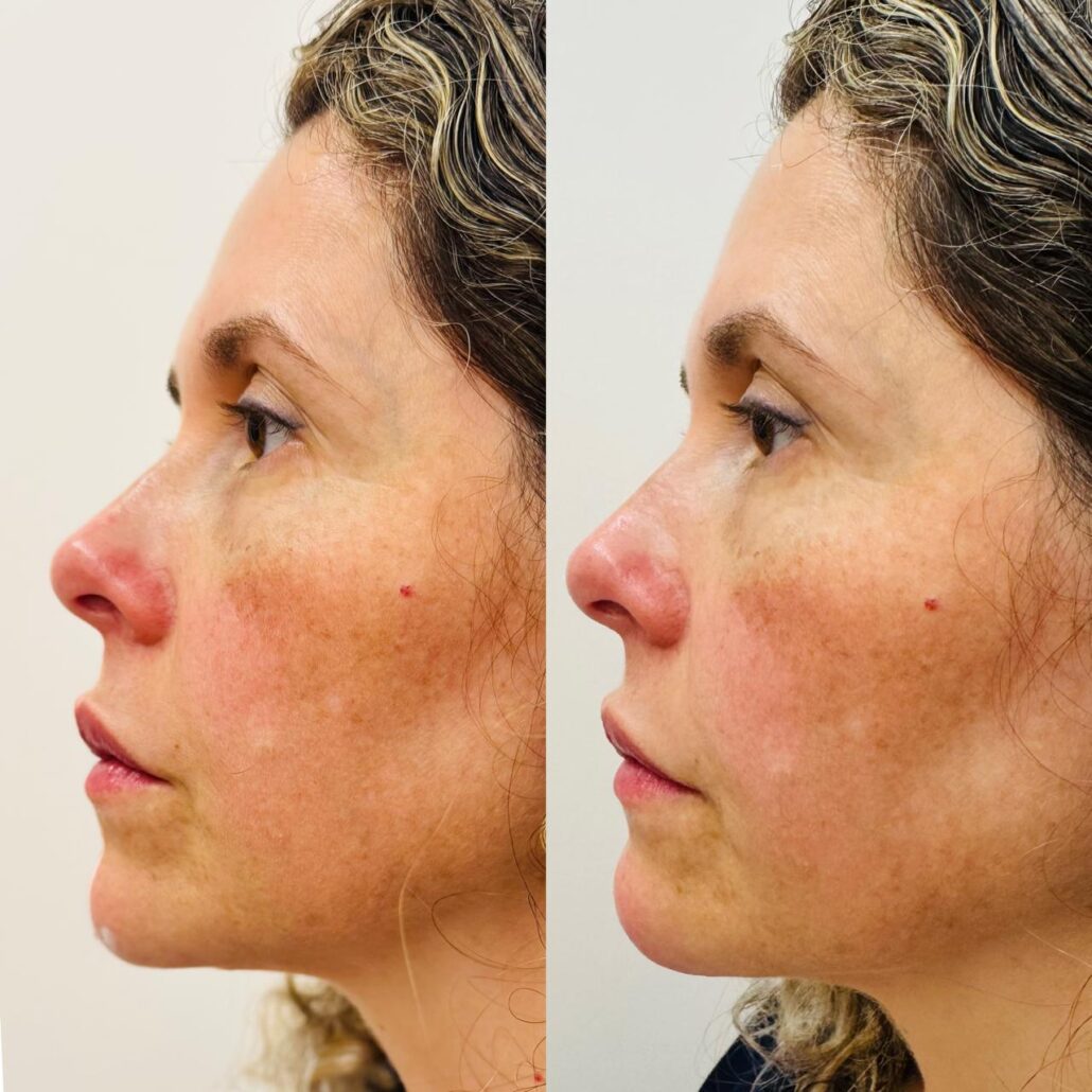 Mulher com o antes e depois após o procedimento de Foto de paciente que realizou o procedimento estético de Preenchimento queixo.