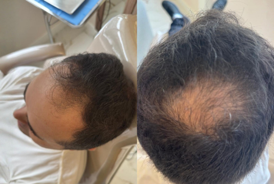 Antes (Inicio do tratamento) Paciente William Monteiro, tratamento da calvice.